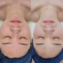 O-1 | 천안 백석동 피부관리 추천｜더레이디뷰티 슈퍼젝션 받고 왔어요(과장X, 1주일 후기사진O)