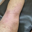 울산연세병원 | 울산피부질환피부과? 대학병원까지 가도 가려움에서 못 벗어나는 분들이 놓친 1가지.