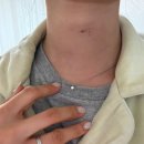새댁 | [20대 새댁의 갑상선암 수술후기1] 결혼 3주 만에 암 진단, 갑상선 세침검사 결과
