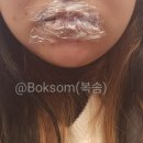 봄눈피우다의원 | 입술필러 맞고 왔던 찐찐 리얼 사진과 후기와 사진 공유해요