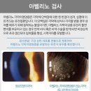 성남스마일약국 | 미금역 연세플러스안과 스마일라식 라섹 성남 분당 추천 후기