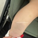 깨금발어린이집 | 중앙대 광명병원 수유실 11개월 아기 이소성반점 시술 레이저 후기 치료중(2차)