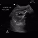 Hydronephrosis with UP junctional stone 이미지