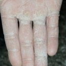 여자들의 고통, 예쁜 손 망치는 피부질환 3가지 이미지