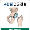 고관절통증 사타구니통증에는 웰튼병원 고관절인공관절수술로!!! 이미지