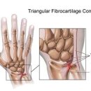 삼각섬유연골(TFCC) 파열로 인한 손목 통증에 대해 아시는 분? 이미지