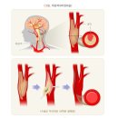 특정뇌혈관질환진단보장 특별약관과 뇌혈관질환진단보장 특별약관의 비교 이미지