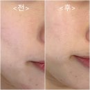 LDM물방울리프팅 효과 김해 율하 피부관리 &#39;데이로제뷰티&#39; 후기