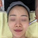 영등포여드름관리 문제성피부전문점 온테라피 후기