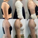 만세한의원 | [공지] 천안 무한 람스_부유방, 팔뚝 영구삭제! 2주차 후기