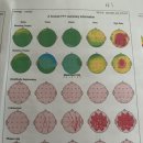 티엠에스 | [후기] rTMS 20회차 후기-우울+불안 환자에게 추천(치료전후 사진 첨부)