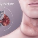 갑상선 기능 저하증[hypothyroidism] 이미지