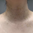 차딱지 | 편평사마귀 제거 9~13일차 리얼후기(딱지 변화&병원진료)