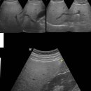 Moderate Fatty liver 이미지