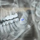 연세퍼스트치과의원 | 수평매볷ㅂ?사랑니(수원 퍼스트사랑니치과의원) 발치 1일차 후기