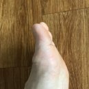 민들레약국 | 무좀연고 추천 사용 후기, 무좀 제대로 치료하는 방법 공유