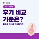 강남 소음순수술 후기 비교 기준은? 와이존 가려움 반복된다면