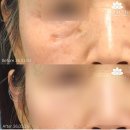 대구기미레이저 사람마다 치료법이 다른 이유 이미지