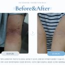 신장군집 | 아토피 아트랄자 주사, 부작용과 듀피젠트 차이점은? 치료 전 꼭 알아야 할 내용