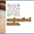 결막모반 증상 제거 원인 알아두면 좋은 눈 건강 정보 이미지