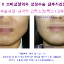 대구성형외과 쁘띠성형 잘하는곳은? 고톡스,보톡스주사,미스코성형,이마필러주사 이미지