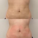 다이아에스테틱 | [압구정]지방흡입 전후관리 강남림프관리하는 다이아에스테틱 압구정점 후기