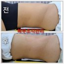 더스무스레푸스 | 대구 북구 칠곡 가인뷰티 더조각 테라피 복부 내장지방 관리 다이어트 샵