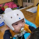 8개월 사두증 아이 경북대학교 병원 두상교정헬멧 착용 시작.(현재 9개월)