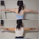 디자인선 | 분당 팔뚝지방추출주사 1주차 후기 팔라인 변화와 멍 붓기 과정