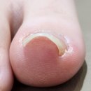 아이풋네일 | 아이 발톱 고민으로 찾은 서초내성발톱 네일은 풋케어 방문 후기