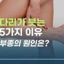 다리부종 원인 및 대처법 다리 붓기 빼는 방법 이미지