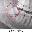 매복 사랑니(Impacted teeth) 치과질환이란? 이미지