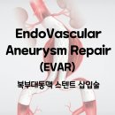 G-MEDICAL | 복부대동맥 스텐트 삽입술 Endovascular aneurysm repair, EVAR