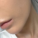 화성동탄피부과 쥬브아셀V 직접 받아본 찐후기