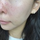 본한의원 | 천안여드름흉터자국 한의원에서 율각테라피 받아본 후기