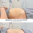 벨리테라피