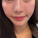 2 | 청담동 쥬베룩볼륨 팔자주름 2차 후기