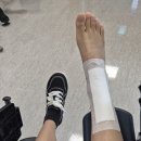 장골 | (발목 변형) 발목 교정술 + 장골 이식 수술 후기＊수술사진 주의