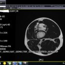 전방십자인대, 반월상 연골 수술 앞두고 있습니다. MRI 판독 부탁드립니다. 이미지