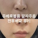 홍대전철역 1,2번출구 | 홍대입구역 피부과 쥬베룩볼륨 인증 병원에서 팔자주름 후기 (효과, 가격, 부작용, 통증)