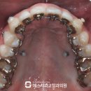 더블유에스치과병원 | 과개교합(딥바이트,Deep-bite) 교정 후기_앞니 장치 부착 순서