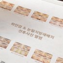 강남성형외과 하안검 + 눈썹 하거상(feat.어머니효도대성공) + 6개월 후기