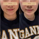 갤러리의원 | 티타늄 리프팅 효과, 청담 안느 의원 후기