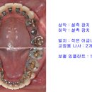 [압구정 치과] 덧니 / 돌출입 / 어금니 브릿지 - 설측교정 이미지