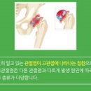 고관절염 원인 진단 고관절 염증 이미지