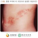 [통합간편]대상포진(30일면책) 진단비 특별약관과 [통합간편]대상포진(30일면책) 진단비(연간1회한) 특별약관의 비교 이미지