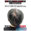 &#34;전주 두피문신 필앤필에스엠피에서 탈모 고민 해결!&#34;