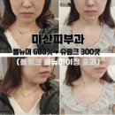 링크유니버스 | 마산피부과 써마지대신 통증없는 볼뉴머600샷+슈링크유니버스300샷 볼링크 후기
