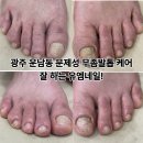 광주 운남동 문제성 무좀발톱 케어 잘 하는 유엠네일(통증이 있었던 고객님의 후기)