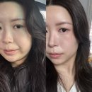 (주)퀘스타정보기술 | 수원 이중턱살 순식간에 박살한! 올타이트리프팅 1주일차 후기